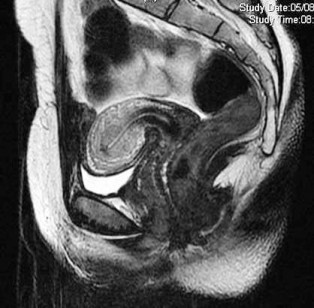 Sagittal MRI scan of a normal female pelvis
